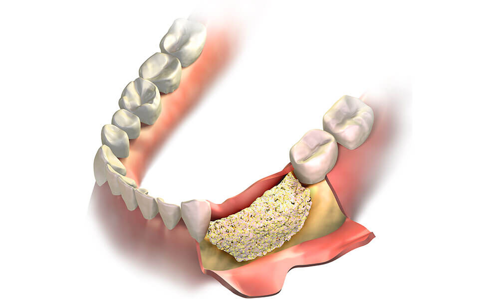 dental-bone-graft