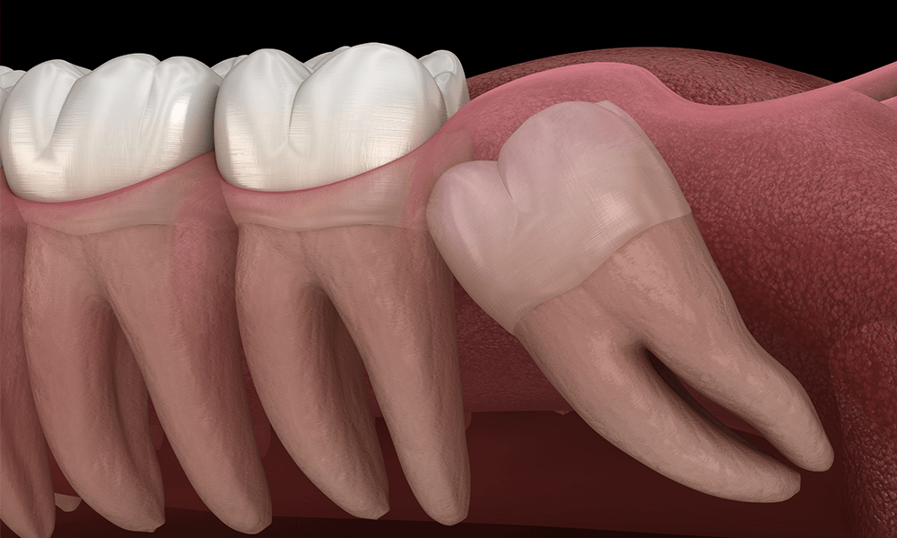 wisdom-teeth-removal-cost