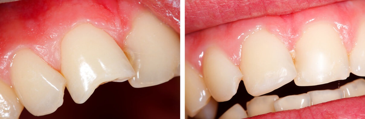 Cracked Tooth Symptoms