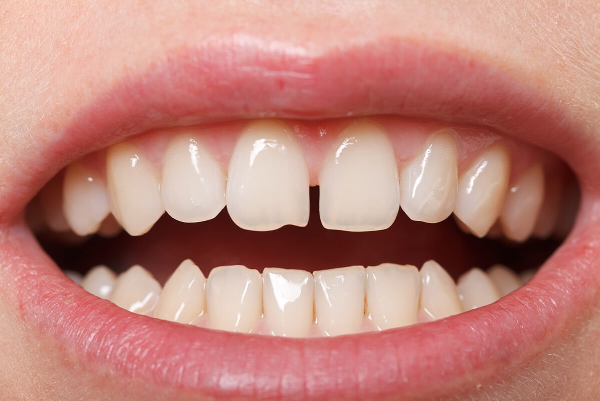 gapped teeth treatment