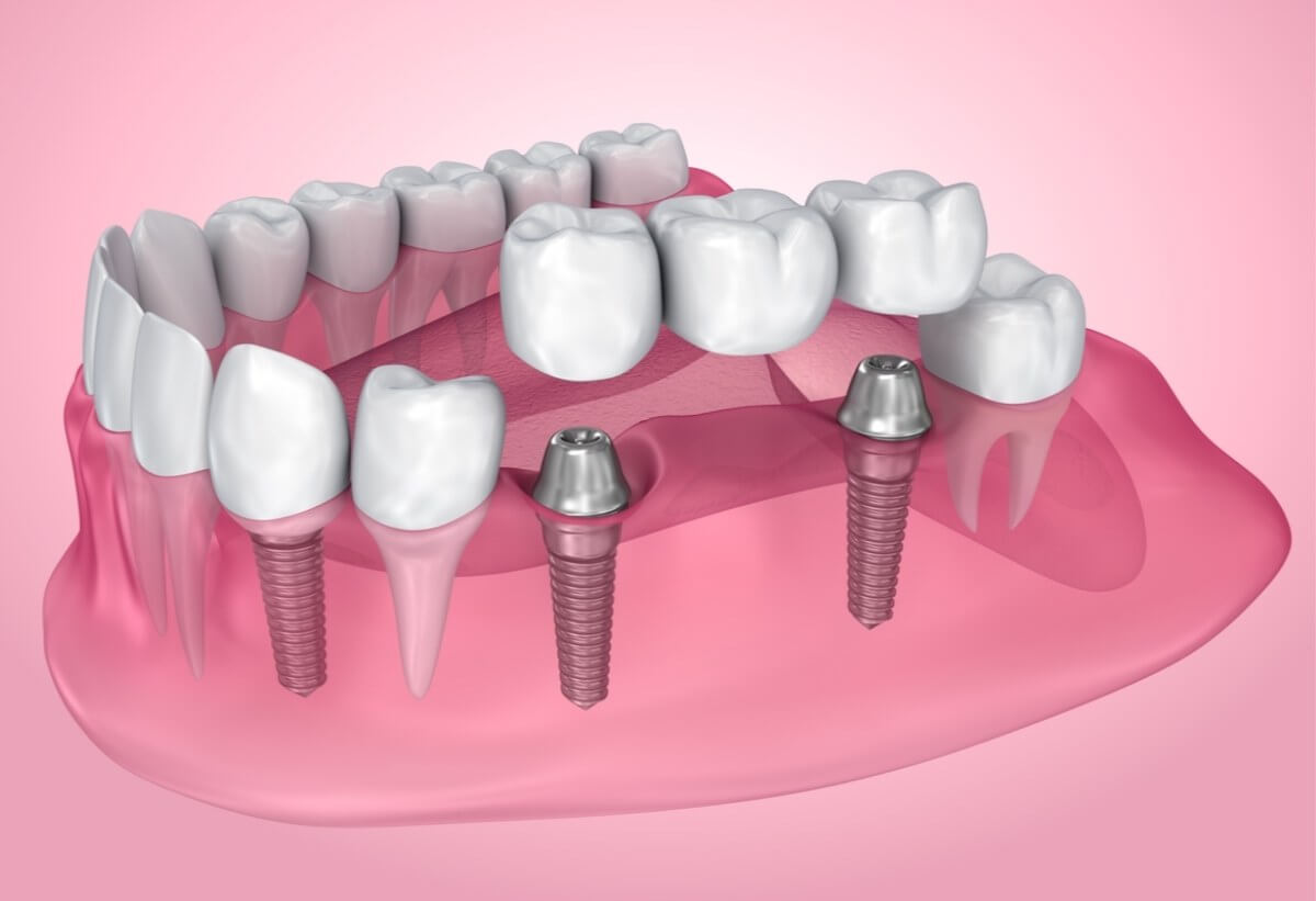 Dental Crowns